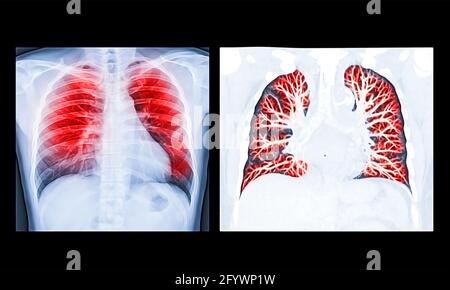 Ölfarbe Wirkung Vergleich von Röntgenbild oder Röntgenbild der Brust Und CT Chest Lung für erkannte Tuberkulose voreingestellt Stockfoto