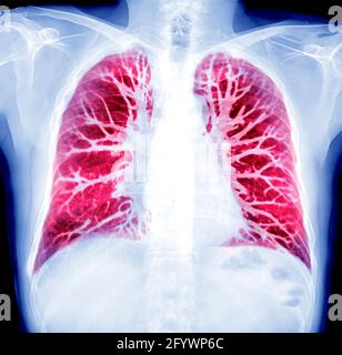 Ölfarbe Wirkung von Thorax-Röntgenbild oder Röntgenbild und Voreinstellung CT Chest Lung für erkannte Tuberkulose Stockfoto