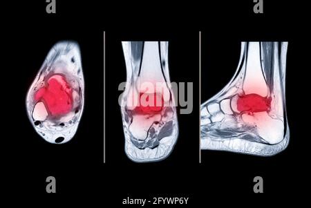 Vergleich der MRT-knöchelaxialen, koronalen und sagittalen PDW-Ansicht mit Knochenmetastasen im Talus. Stockfoto