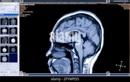 MRT-Gehirn sagittale T1-Ansicht zur Detektion einer Vielzahl von Erkrankungen des Gehirns wie Zysten, Tumoren, Blutungen isoliert auf dem Bildschirm. Stockfoto