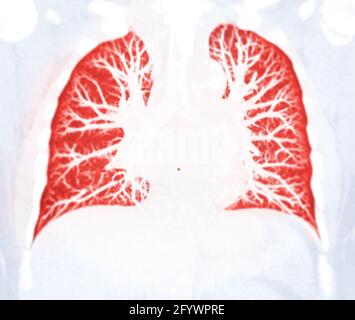 CT Chest Lung Preset für erkannte Tuberkulose-Tuberkulose (TB) und Coronavirus 2019. Stockfoto