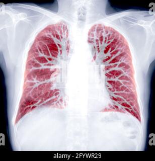 CT Chest Lung Preset für erkannte Tuberkulose-Tuberkulose (TB) und Coronavirus 2019. Stockfoto