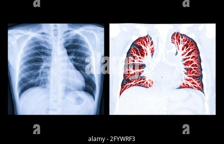 Vergleich von Thorax-Röntgen- oder Röntgenbild und CT-Thorax-Lungen-Voreinstellung für erkannte Tuberkulose-Tuberkulose (TB) und Coronavirus 2019. Stockfoto