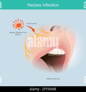 Herpesinfektion. Illustration menschliche Gesichtsnerv Haut für den Einsatz erklären Herpes-simplex-Virus Lippinfektion. Stock Vektor