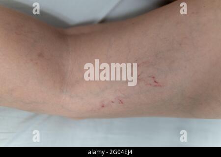 Entfernung von Blutgefäßen durch Laser Dermatologie Krankheit, Bein Schönheit, Anatomie. Risiko bis Teleangiektasen physisch Stockfoto