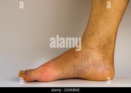Ansicht des rechten alten Mannes Fuß, schmerzhaft, Rötung, geschwollen und Zärtlichkeit des Großzehengelenks durch akute Arthritis Gicht. Stockfoto