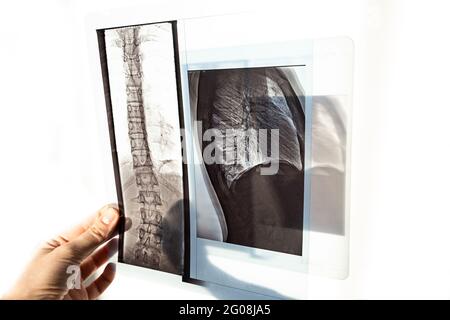 Röntgenaufnahme der Knochen des Rückens der Wirbel, der Lunge und des Brustkorbs bei Skoleose und Krümmung der Wirbelsäule Stockfoto