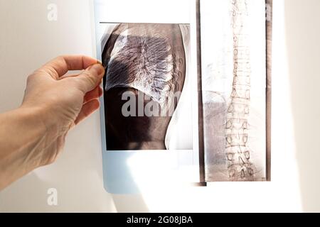 Röntgenaufnahme der Knochen des Rückens der Wirbel, der Lunge und des Brustkorbs bei Skoleose und Krümmung der Wirbelsäule. Stockfoto