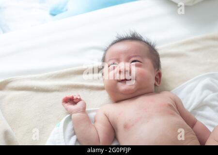 Hautausschläge bei Babys Stockfoto