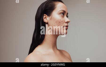 Seitenansicht Porträt einer Frau mit Akne. Nahaufnahme der traurigen Frau mit Hautproblem. Stockfoto