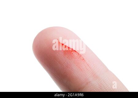 Menschlicher Finger mit einem Schnitt, eine Folge von Hautschäden und offenen Blutungen aus Kratzern am Körper des Patienten, in Nahaufnahme isoliert auf weißem Hintergrund. Stockfoto