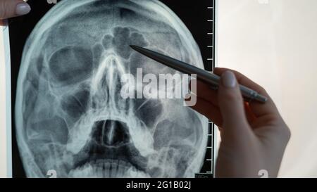 Röntgenaufnahme des menschlichen Kopfes. Der Arzt weist auf die Anzeichen einer Sinusitis hin Stockfoto