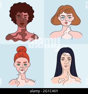 Welt-Vitiligo-Tag. Frauen Gesichter, die Vitiligo Pigmentflecken haben. Isolierte Porträts – Vektorset Stock Vektor