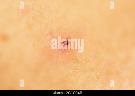 Verletztes trocknendes hängendes Muttermal am Hals. Stockfoto