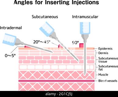 Vektordarstellung „Winkel zum Einfügen von Injektionen“ Stock Vektor