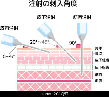 Vektordarstellung „Winkel zum Einfügen von Injektionen“ Stock Vektor
