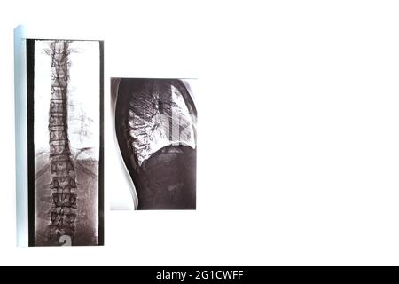 Röntgenaufnahme der Knochen des Rückens der Wirbel, der Lunge und des Brustkorbs bei Skoleose und Krümmung der Wirbelsäule Stockfoto