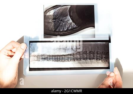 Röntgenaufnahme der Knochen des Rückens der Wirbel, der Lunge und des Brustkorbs bei Skoleose und Krümmung der Wirbelsäule Stockfoto