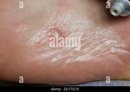 Dyshidrotisches Ekzem am Fuß. Blasendermatitis. Mit Salbe behandelt. Nahaufnahme. Stockfoto