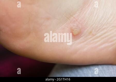 Dyshidrotisches Ekzem am Fuß. Blasendermatitis. Nahaufnahme. Stockfoto