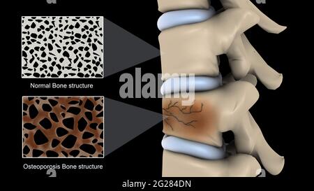 Osteoporose an der Wirbelsäule, mit vergrößerten Abschnitten im Vergleich zu normalen Knochenstrukturen. Stockfoto