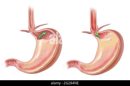 Normales geschlossenes Pylorventil und undichtes Ventil mit GERD. Stockfoto