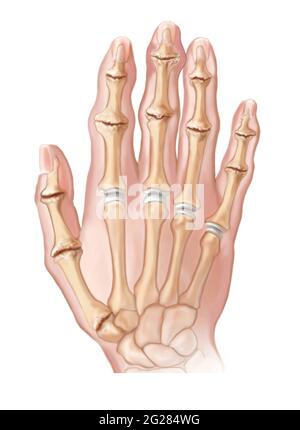 Hand mit osteoarthritischen Gelenken. Stockfoto