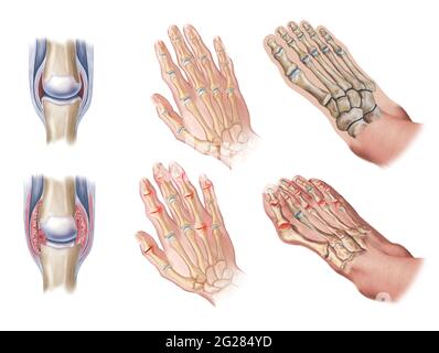 Detail der entzündlichen Gelenke. Normale (oben) vs. Psoriatische Hände- und Fußgelenke (unten). Stockfoto