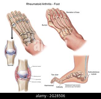 Ober- und Seitenansicht des Fußes mit Fehlbildungen, die durch rheumatoide Arthritis verursacht werden. Stockfoto