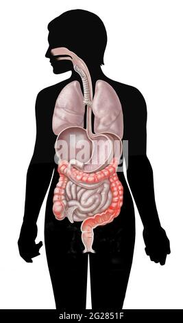 Lage der Colitis ulcerosa im Dickdarm auf der weiblichen Silhouette. Stockfoto