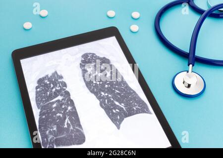 Tablet-Computer mit Lunge-Röntgen und Stethoskop und Pillen auf blauem Hintergrund. Konzept für Lungenerkrankungen Stockfoto