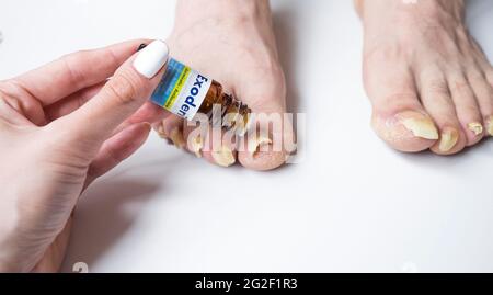 April 2021,Bukarest, Rumänien. Frau wendet Exoderil, Nagelpilz-Behandlung auf infizierte lange Nägel des Mannes an Stockfoto