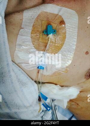 Mann nach kolorektaler Krebschirurgie, Pneumothorax Chest Drain Chest verbunden mit einer mit Flüssigkeit gefüllten Flasche und anderen Drainagerohren Stockfoto