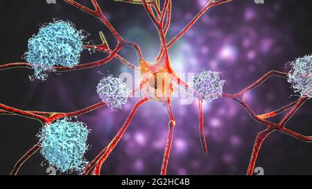 Nervenzellen, die von der Alzheimer-Krankheit betroffen sind, Illustration Stockfoto