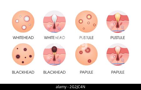 Setzen Sie verschiedene Gesichtshaut Pickel Akne-Typen Pore comedones Kosmetik Hautprobleme Konzept flach horizontal Stock Vektor