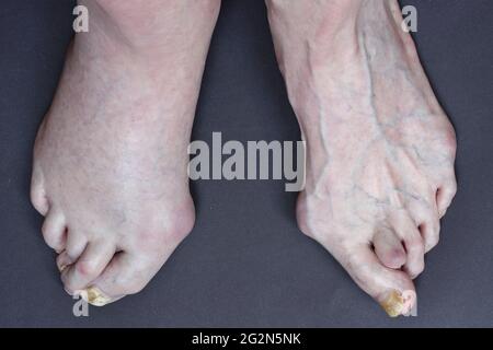 Drei Probleme bei einem 74-jährigen Mann: Fehlstellung des menschlichen Fußes - Hallux Valgus, diagnostizierte Thrombose am rechten Bein und Pilzinfektionen im Nagel Stockfoto