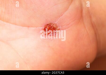 Detail einer offenen abrasiven Wunde an der Hand mit dem hautdurchsickernden Serum. Stockfoto