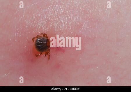 Lone Star Tick, Amblyomma americanum, Nymphe an der menschlichen Haut befestigt Stockfoto