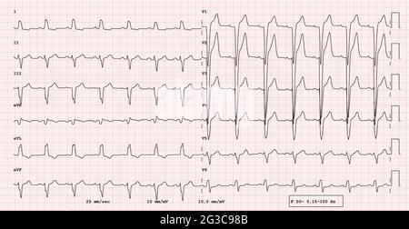 EKG-Beispiel für 12-Kanal-Rhythmus, Linksschenkelblock, reale Untersuchung Stockfoto