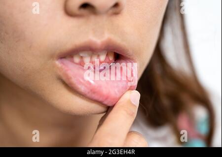 Nahaufnahme asiatische Frau haben aphthous Geschwulst oder Canker Wunde auf Mund an der Lippe Stockfoto