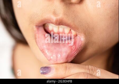 Nahaufnahme asiatische Frau haben aphthous Geschwulst oder Canker Wunde auf Mund an der Lippe Stockfoto