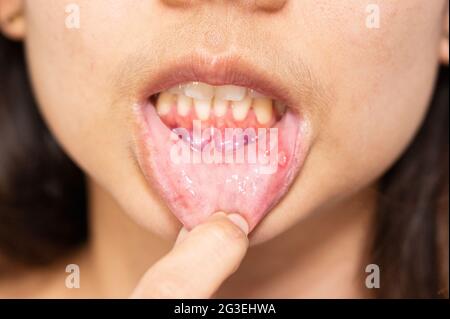 Nahaufnahme asiatische Frau haben aphthous Geschwulst oder Canker Wunde auf Mund an der Lippe Stockfoto