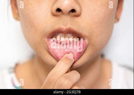 Nahaufnahme asiatische Frau haben aphthous Geschwulst oder Canker Wunde auf Mund an der Lippe Stockfoto