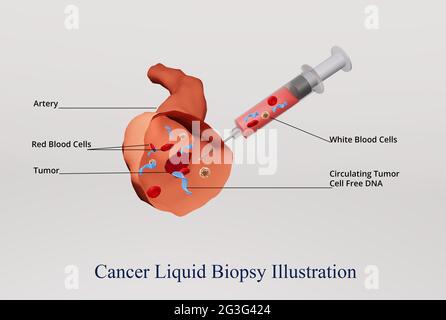 3d-Illustration eines Biopsieprozesses mit Krebsflüssigkeit, der die Extraktion von tumorzellfreier DNA darstellt Stockfoto