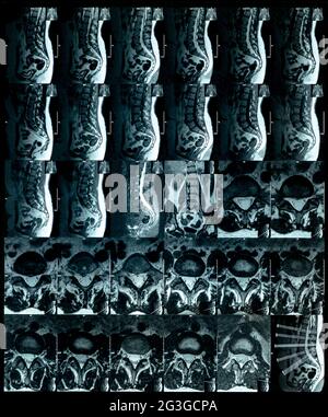 Magnetresonanztomographie Wirbelsäulenscheiben Vorwölbung Laborfilm Stockfoto