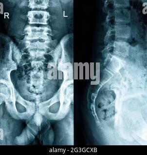 Beckenknochen zwei Positionen prüfen den schwarzen Hintergrund des Roentgenogramms Stockfoto