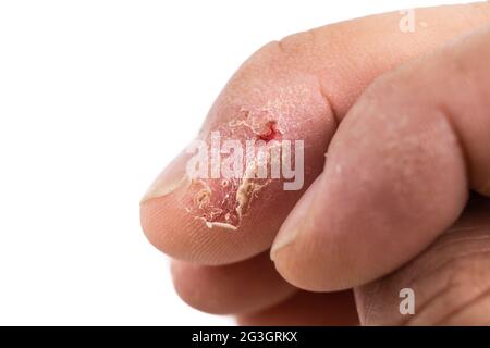 Nahaufnahme von schmerzhaft entzündet geschädigter trockener Haut am Finger Stockfoto