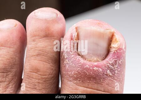 Nahaufnahme einer schmerzhaften entzündeten Infektion der Großzehe durch eingewachsenen Zehennagel Stockfoto