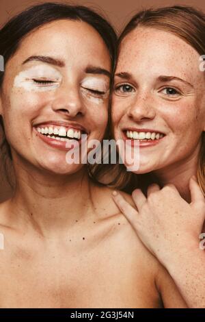 Nahaufnahme von zwei lächelnden Frauen mit unterschiedlicher Haut. Porträt von Frauen mit Vitiligo und Sommersprossen. Stockfoto