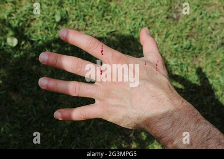 Die Hand des Mannes wurde von einer Katze im Garten frisch zerkratzt. Frisches Blut kommt aus der Hautschicht. Spritzer von Bluttropfen auf einer weißen Blume Stockfoto